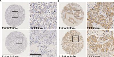 High Expression of microRNA-223 Indicates a Good Prognosis in Triple-Negative Breast Cancer